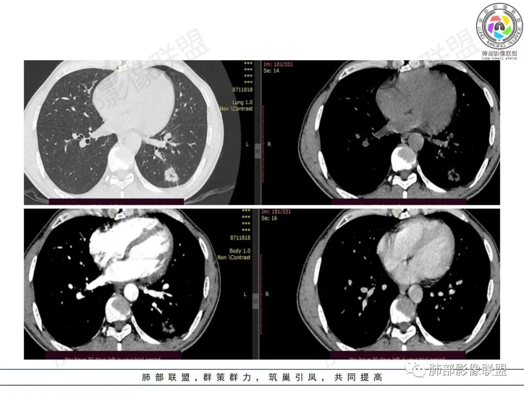 影像PPT - 【病例】HIV背景下的肺结节-16 影像PPT - 【病例】HIV背景下的肺结节-16