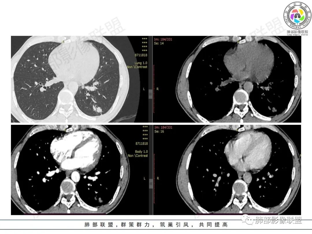 影像PPT - 【病例】HIV背景下的肺结节-17 影像PPT - 【病例】HIV背景下的肺结节-17