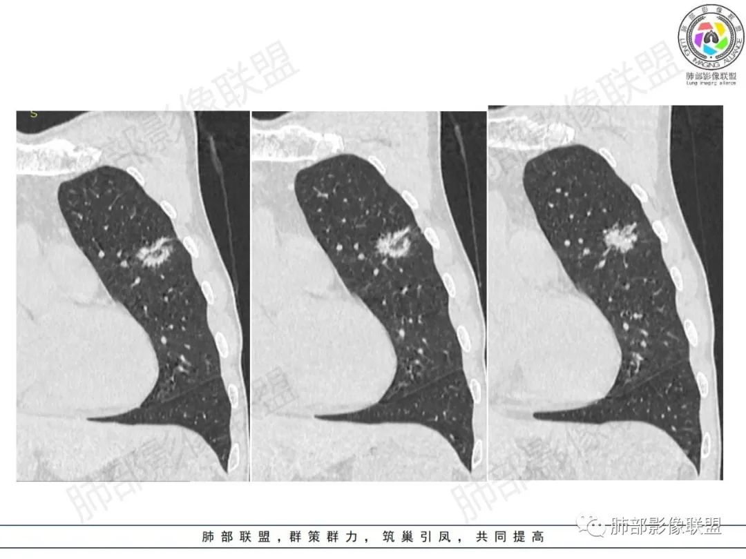 影像PPT - 【病例】HIV背景下的肺结节-18 影像PPT - 【病例】HIV背景下的肺结节-18