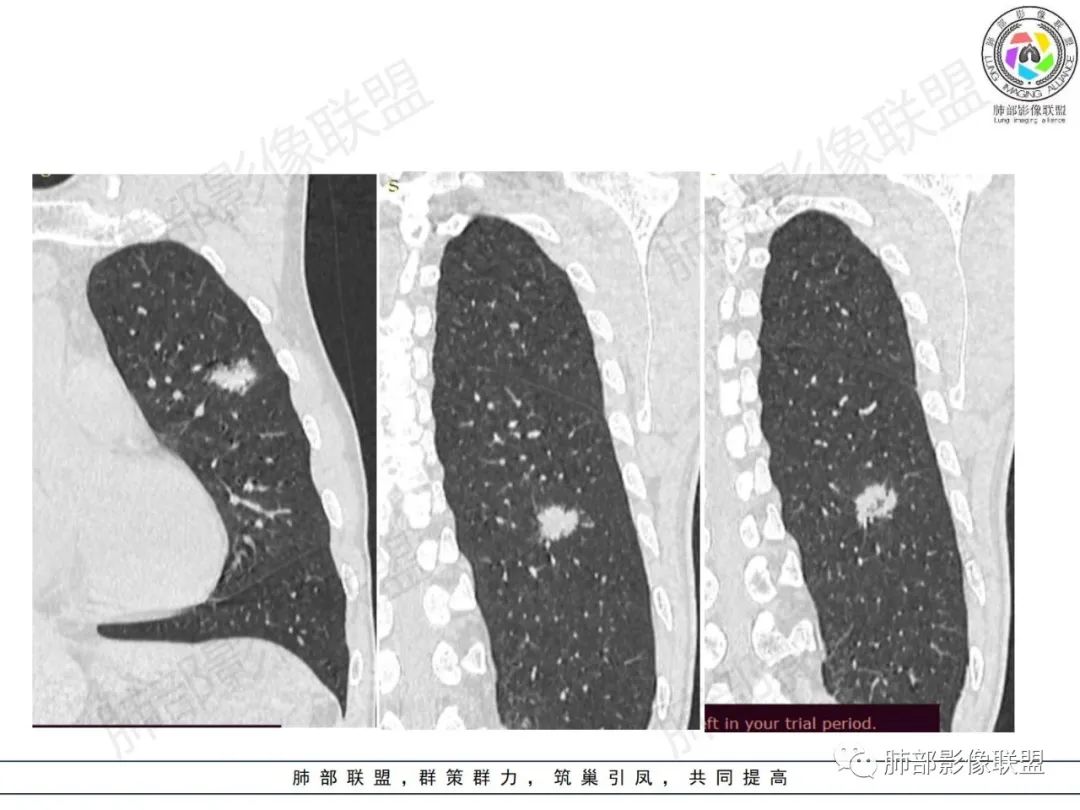 影像PPT - 【病例】HIV背景下的肺结节-19 影像PPT - 【病例】HIV背景下的肺结节-19