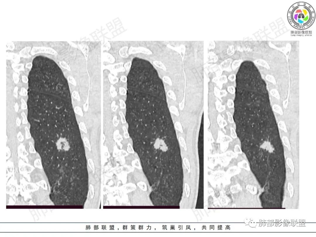 影像PPT - 【病例】HIV背景下的肺结节-20 影像PPT - 【病例】HIV背景下的肺结节-20