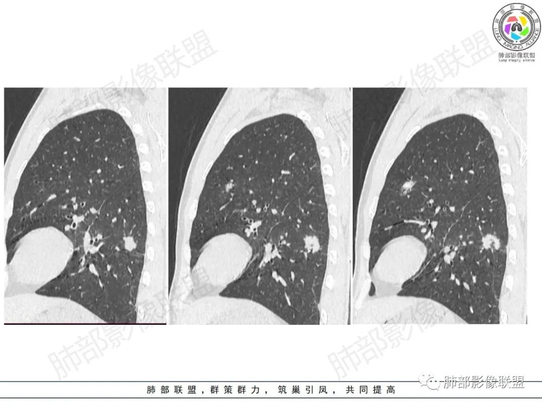 影像PPT - 【病例】HIV背景下的肺结节-21 影像PPT - 【病例】HIV背景下的肺结节-21