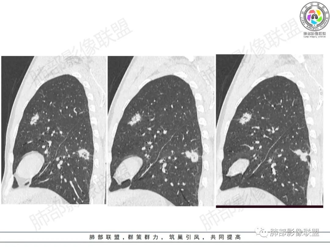 影像PPT - 【病例】HIV背景下的肺结节-22 影像PPT - 【病例】HIV背景下的肺结节-22
