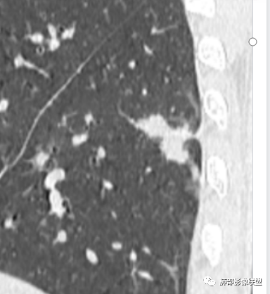 影像PPT - 【病例】HIV背景下的肺结节-30 影像PPT - 【病例】HIV背景下的肺结节-30