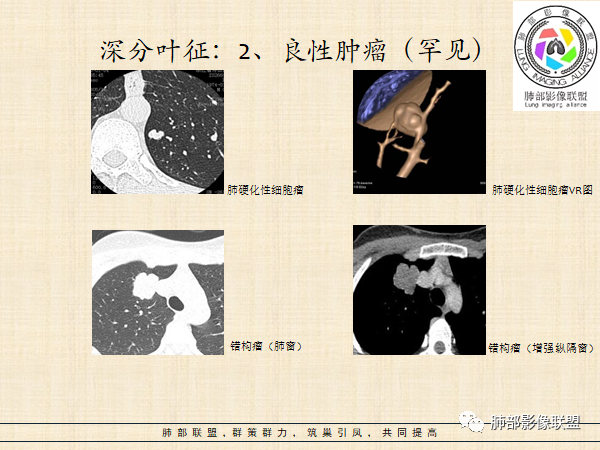 影像PPT - 【病例】HIV背景下的肺结节-31 影像PPT - 【病例】HIV背景下的肺结节-31