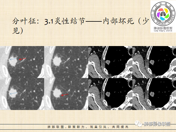 影像PPT - 【病例】HIV背景下的肺结节-32 影像PPT - 【病例】HIV背景下的肺结节-32