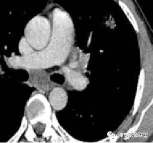 影像PPT - 【病例】HIV背景下的肺结节-35 影像PPT - 【病例】HIV背景下的肺结节-35