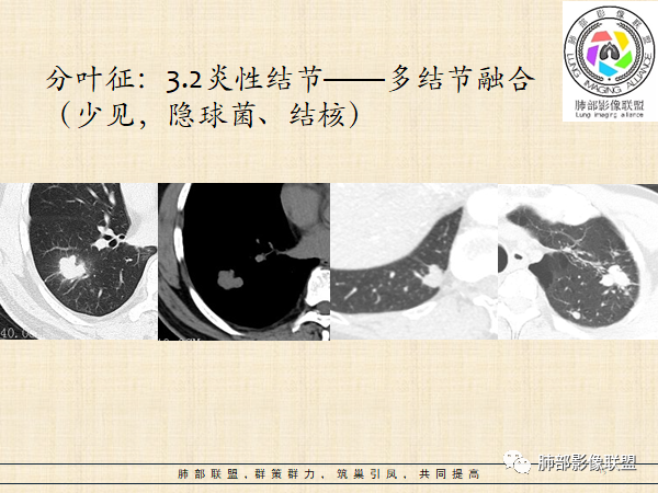 影像PPT - 【病例】HIV背景下的肺结节-33 影像PPT - 【病例】HIV背景下的肺结节-33