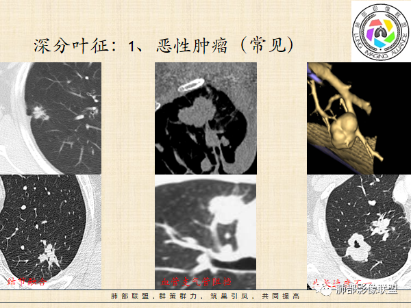 影像PPT - 【病例】HIV背景下的肺结节-34 影像PPT - 【病例】HIV背景下的肺结节-34