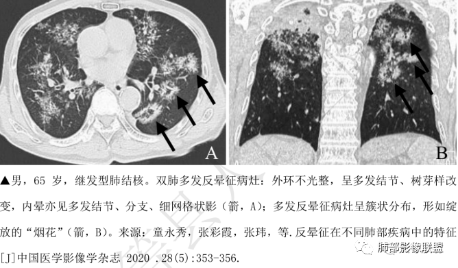 影像PPT - 【病例】HIV背景下的肺结节-40 影像PPT - 【病例】HIV背景下的肺结节-40