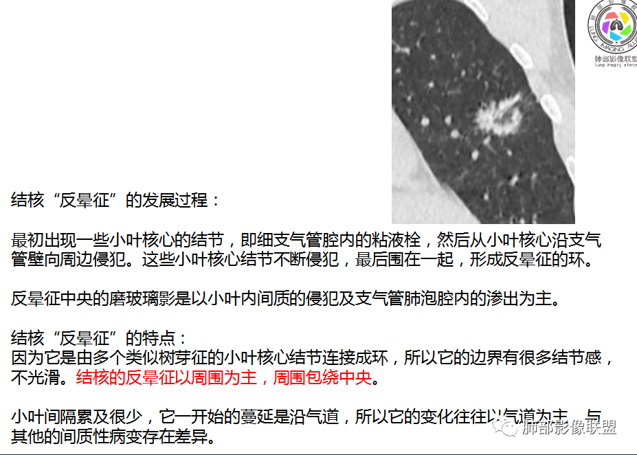 影像PPT - 【病例】HIV背景下的肺结节-41 影像PPT - 【病例】HIV背景下的肺结节-41