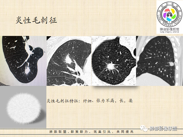 影像PPT - 【病例】HIV背景下的肺结节-44 影像PPT - 【病例】HIV背景下的肺结节-44
