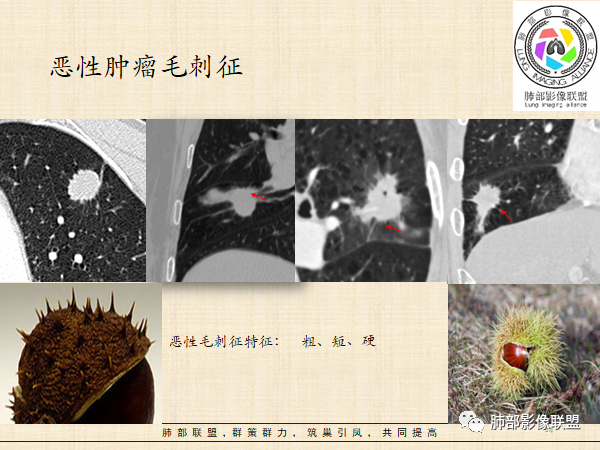 影像PPT - 【病例】HIV背景下的肺结节-43 影像PPT - 【病例】HIV背景下的肺结节-43