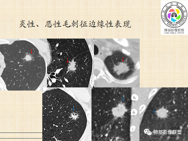 影像PPT - 【病例】HIV背景下的肺结节-45 影像PPT - 【病例】HIV背景下的肺结节-45