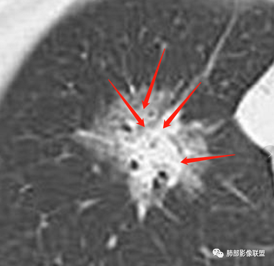 影像PPT - 【病例】HIV背景下的肺结节-47 影像PPT - 【病例】HIV背景下的肺结节-47