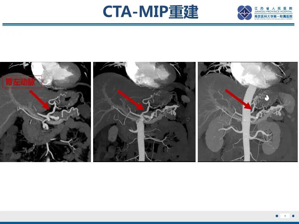 影像PPT - 【PPT】胃恒径动脉综合征-7