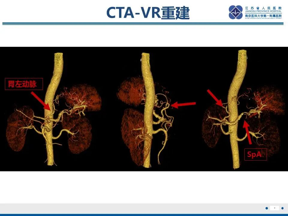 影像PPT - 【PPT】胃恒径动脉综合征-8