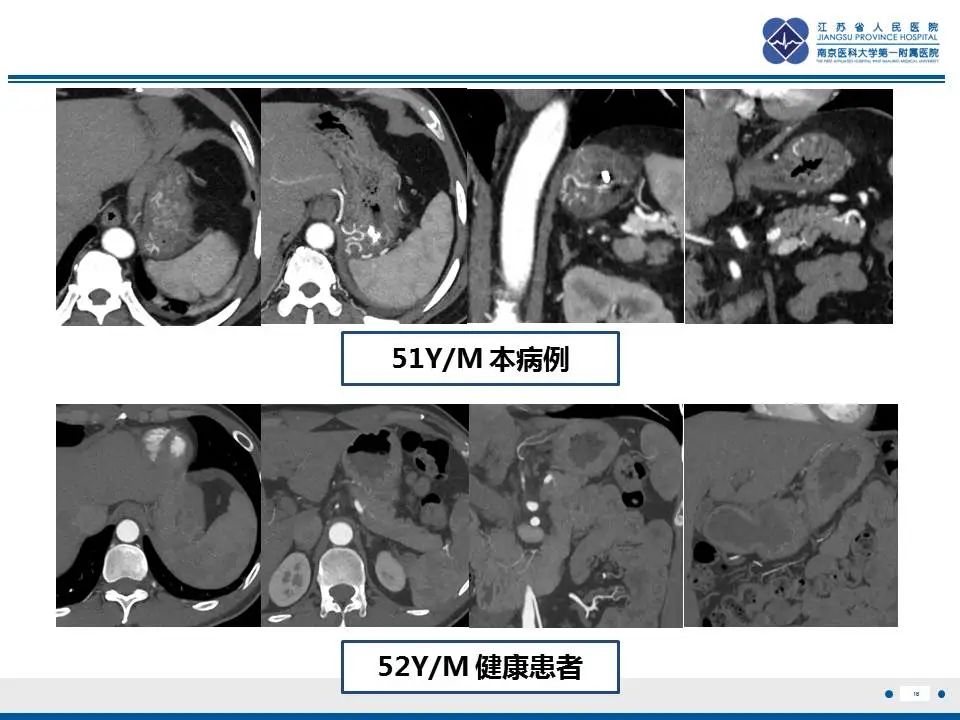 影像PPT - 【PPT】胃恒径动脉综合征-17