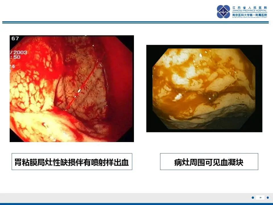影像PPT - 【PPT】胃恒径动脉综合征-27
