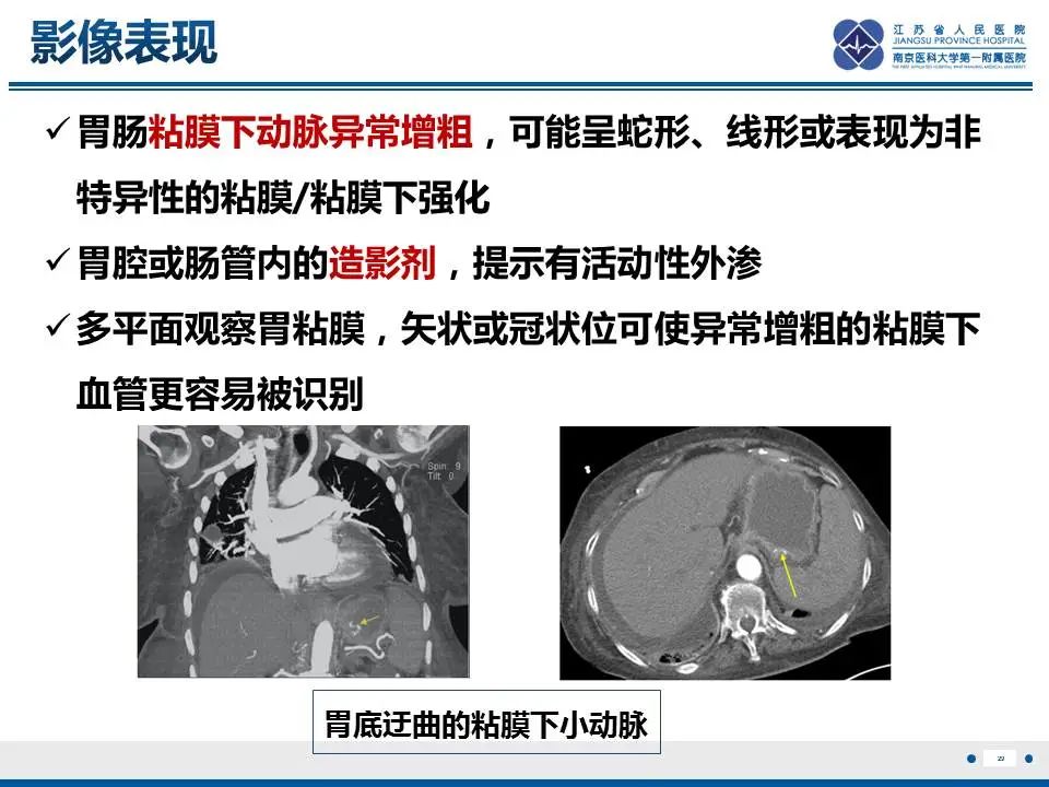 影像PPT - 【PPT】胃恒径动脉综合征-30