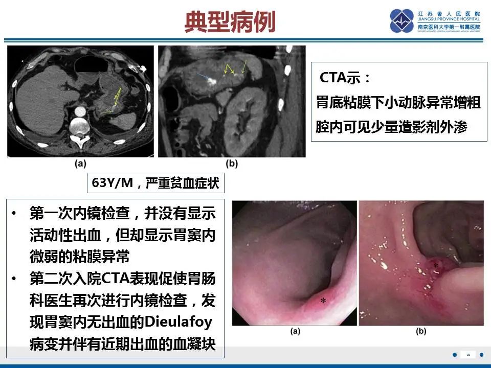 影像PPT - 【PPT】胃恒径动脉综合征-31