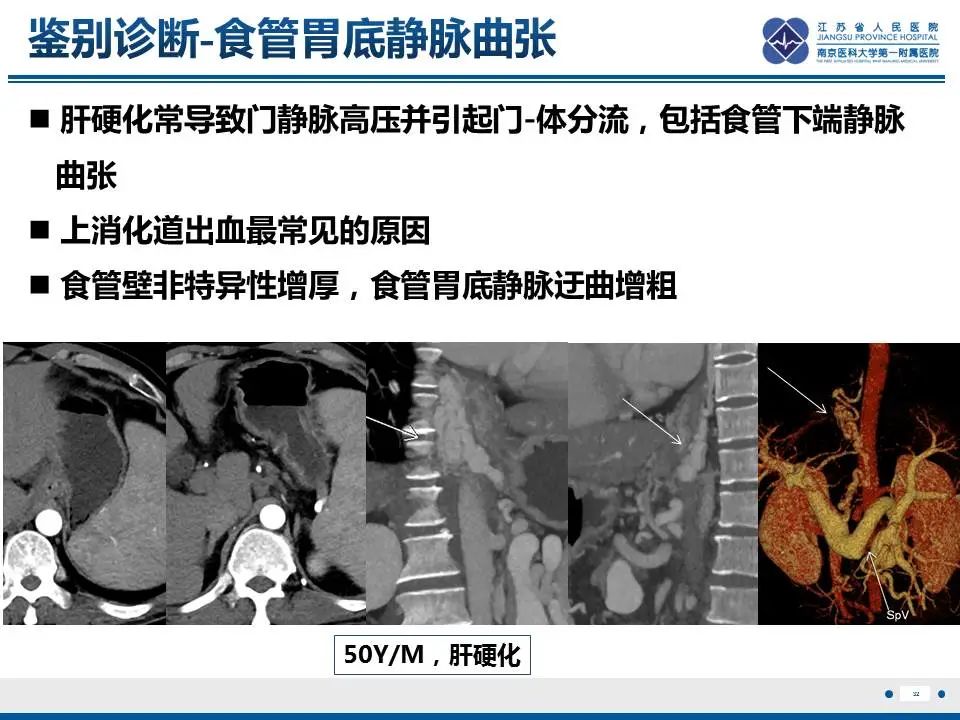 影像PPT - 【PPT】胃恒径动脉综合征-33