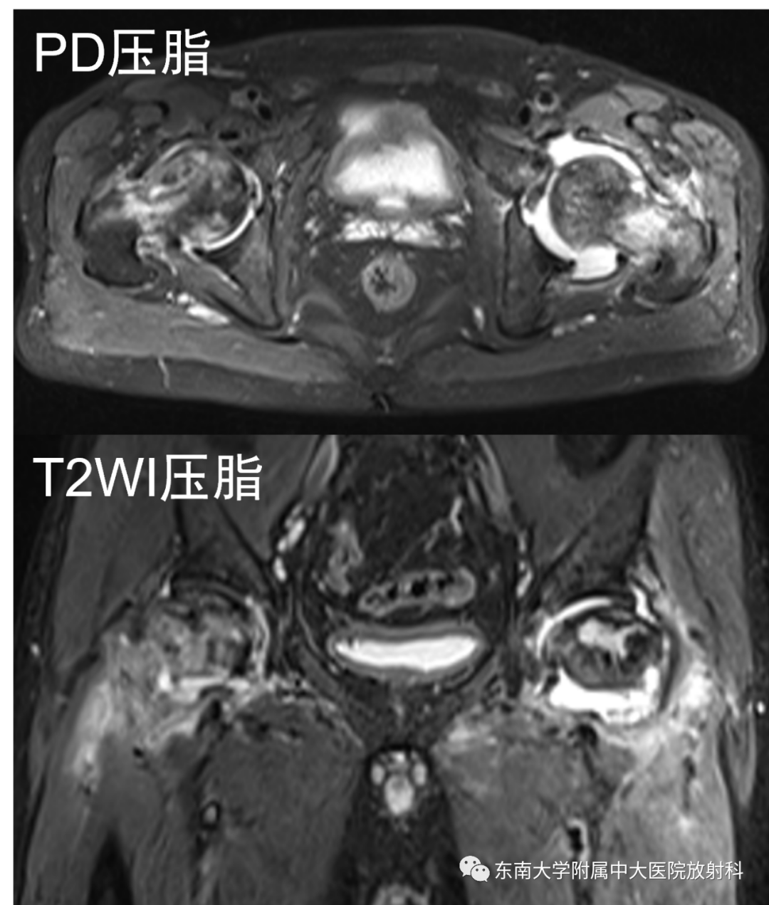 影像PPT - 【PPT】成人非外伤性股骨头缺血性坏死-2