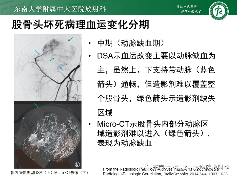影像PPT - 【PPT】成人非外伤性股骨头缺血性坏死-9