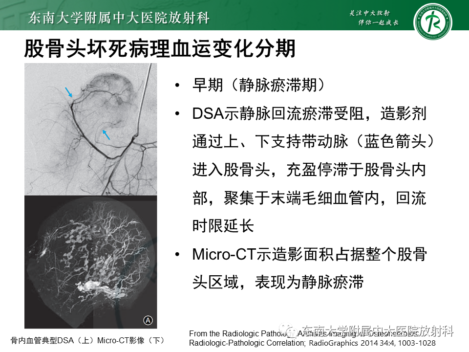 影像PPT - 【PPT】成人非外伤性股骨头缺血性坏死-8