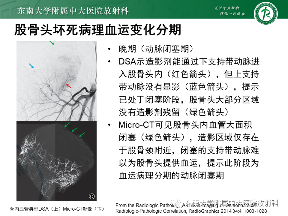 影像PPT - 【PPT】成人非外伤性股骨头缺血性坏死-10
