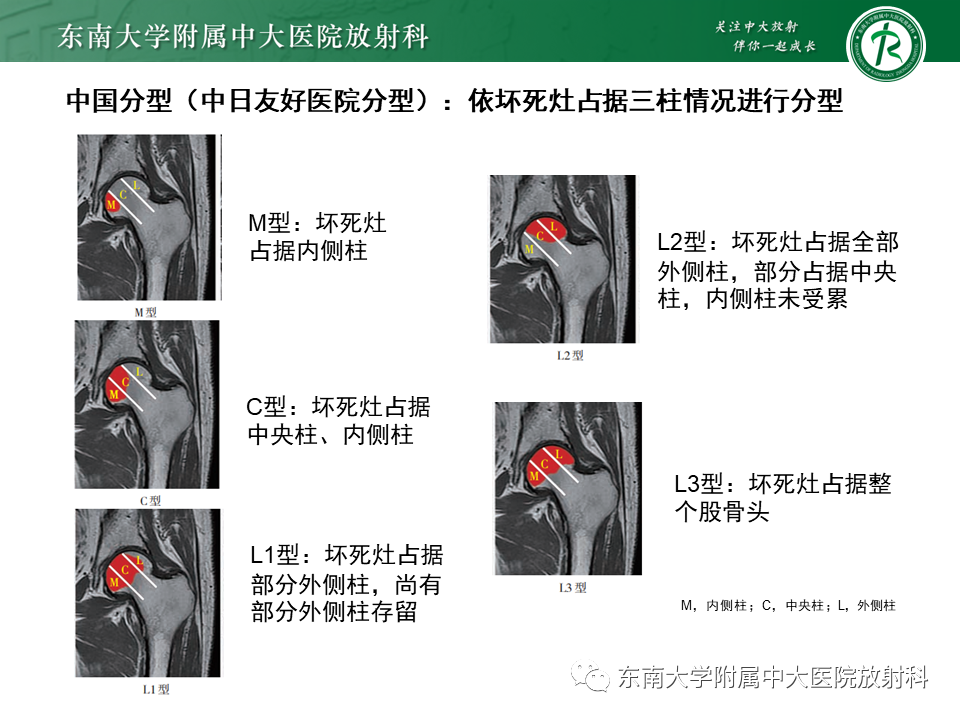 影像PPT - 【PPT】成人非外伤性股骨头缺血性坏死-16
