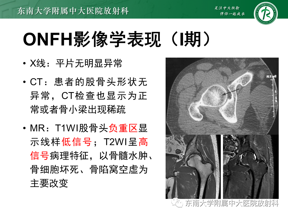 影像PPT - 【PPT】成人非外伤性股骨头缺血性坏死-17