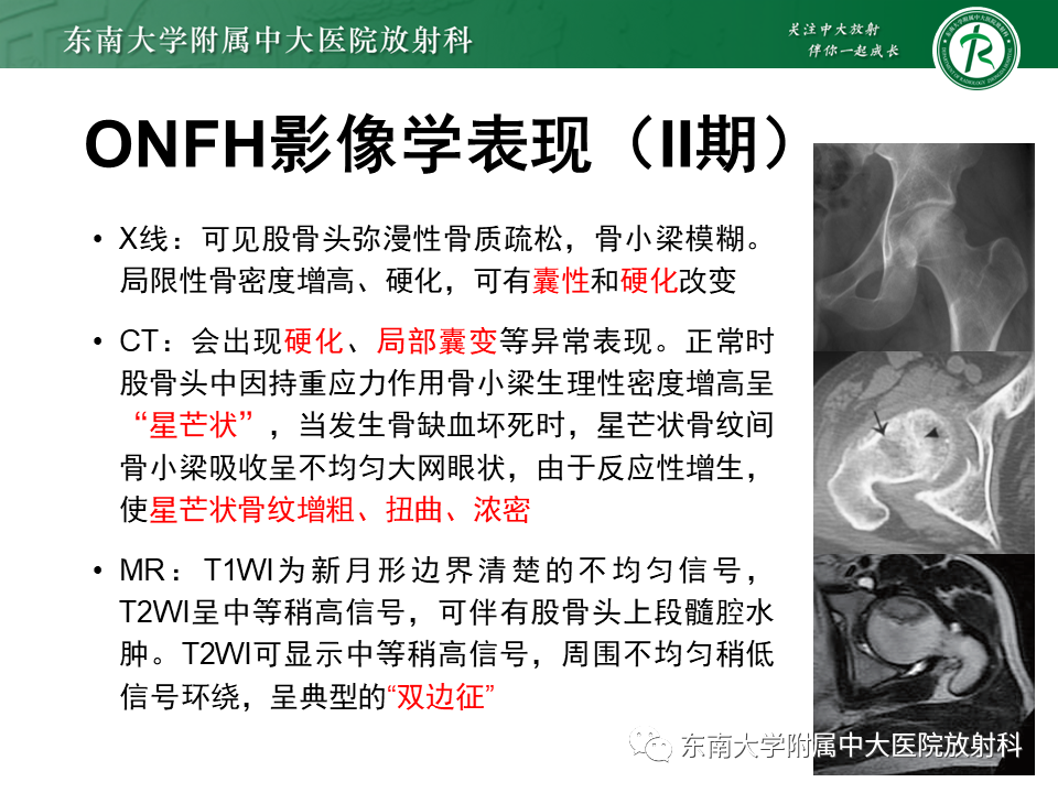 影像PPT - 【PPT】成人非外伤性股骨头缺血性坏死-18