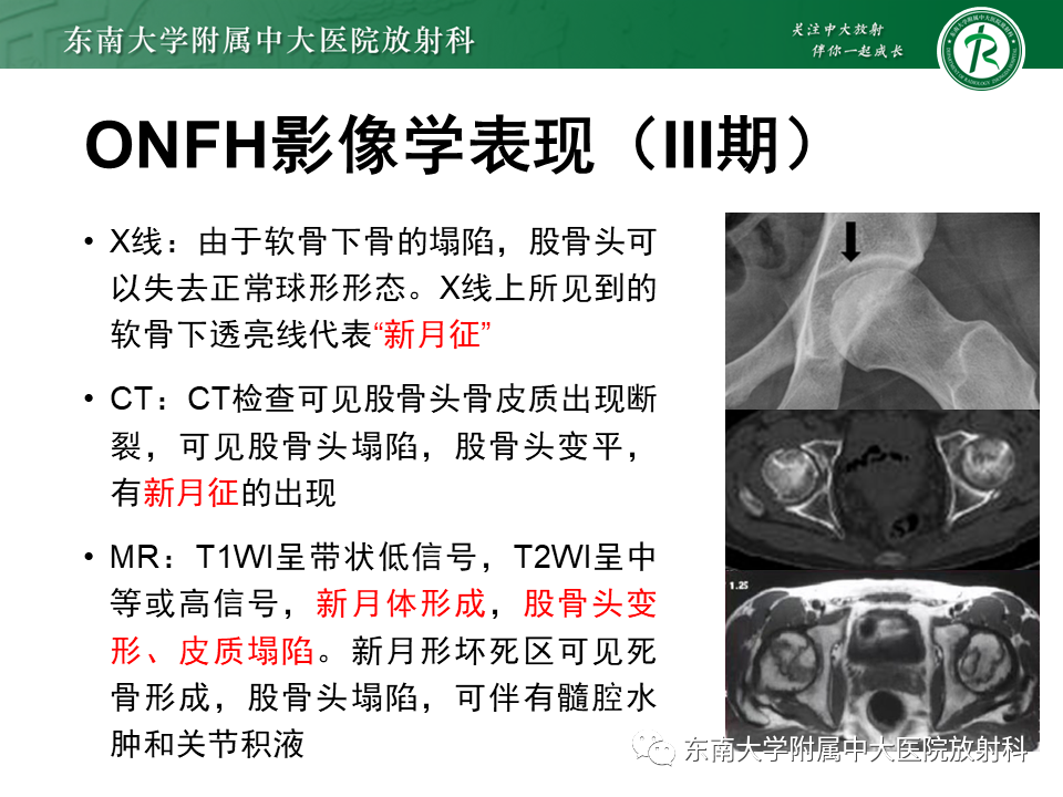 影像PPT - 【PPT】成人非外伤性股骨头缺血性坏死-19