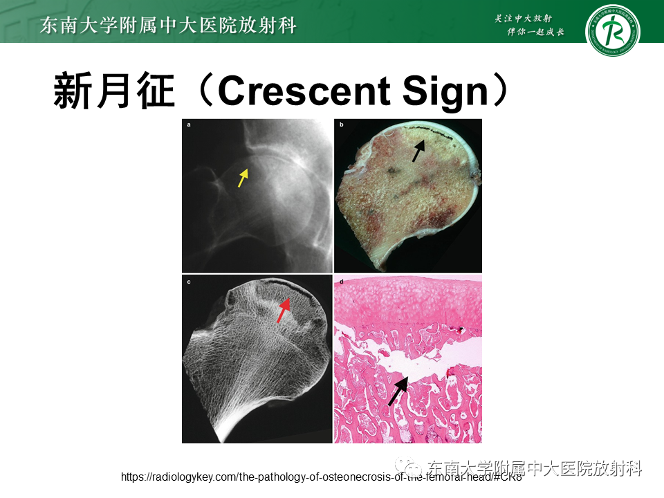 影像PPT - 【PPT】成人非外伤性股骨头缺血性坏死-20