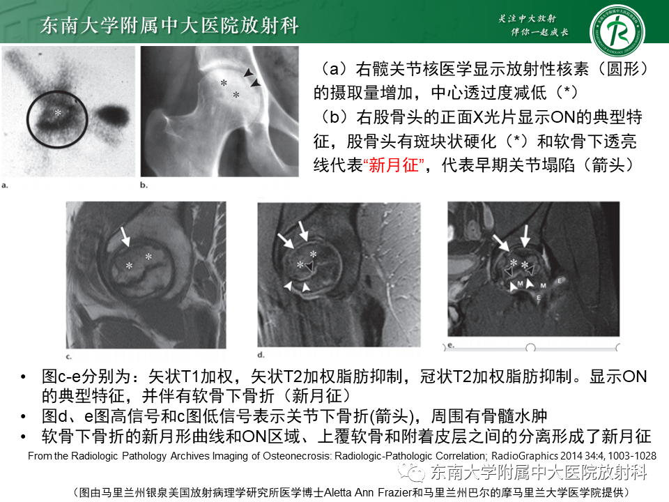 影像PPT - 【PPT】成人非外伤性股骨头缺血性坏死-21
