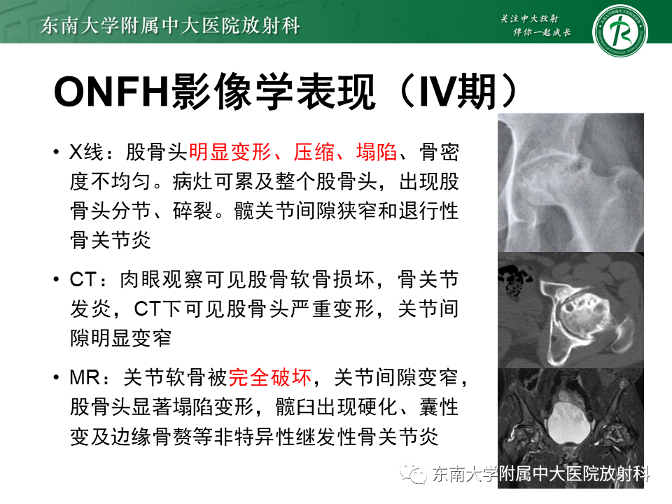 影像PPT - 【PPT】成人非外伤性股骨头缺血性坏死-22