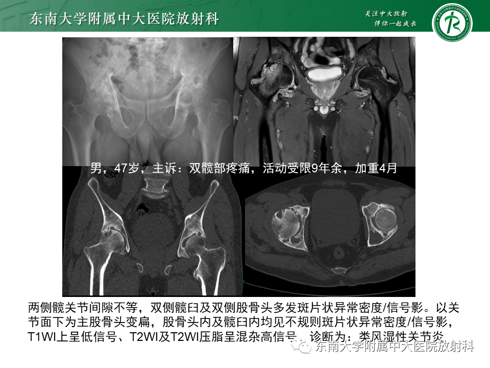影像PPT - 【PPT】成人非外伤性股骨头缺血性坏死-25