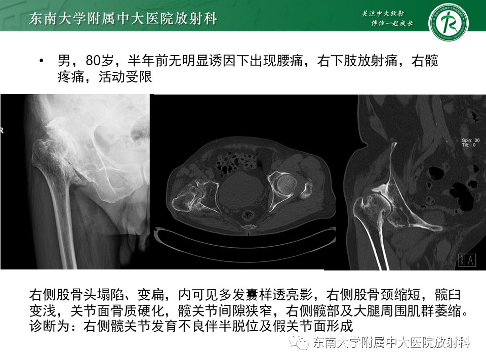 影像PPT - 【PPT】成人非外伤性股骨头缺血性坏死-27