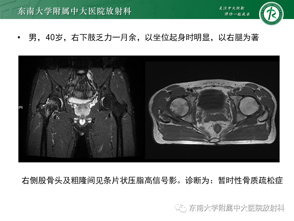 影像PPT - 【PPT】成人非外伤性股骨头缺血性坏死-29