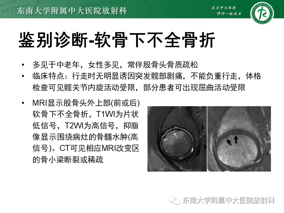 影像PPT - 【PPT】成人非外伤性股骨头缺血性坏死-32