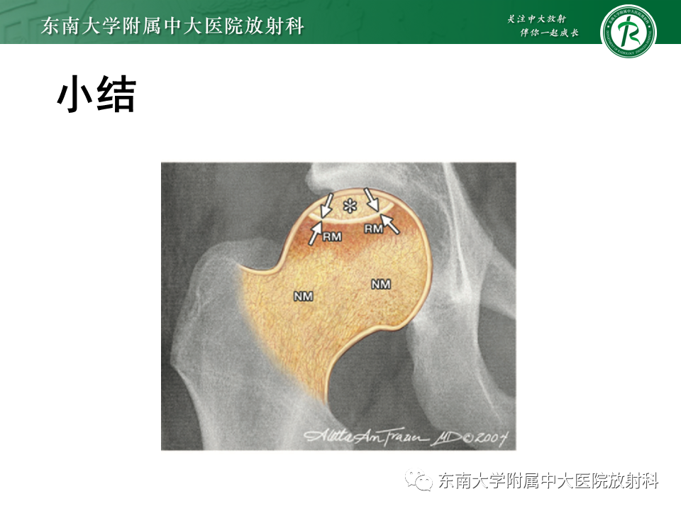 影像PPT - 【PPT】成人非外伤性股骨头缺血性坏死-34