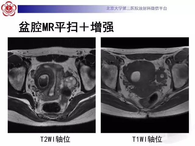 影像PPT - 【PPT】子宫腺肌病-3
