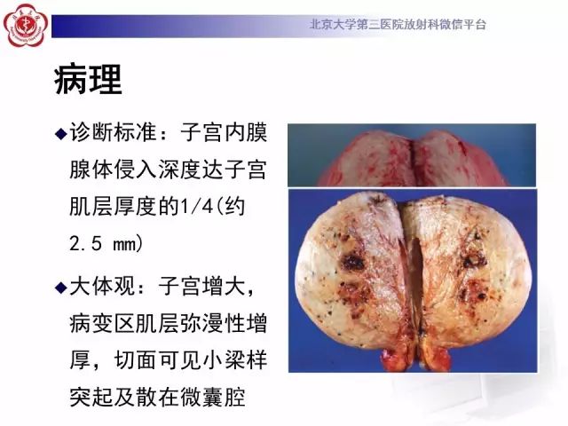 影像PPT - 【PPT】子宫腺肌病-13