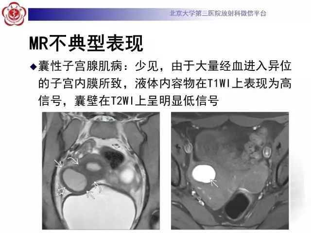 影像PPT - 【PPT】子宫腺肌病-25