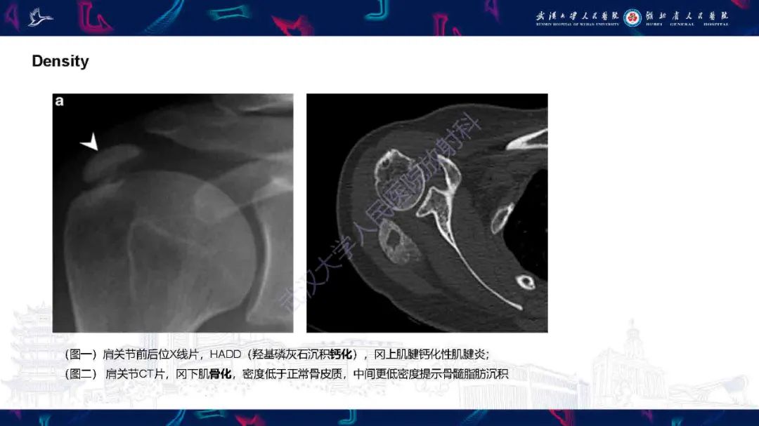 影像PPT - 【PPT】软组织钙化影像诊断-6