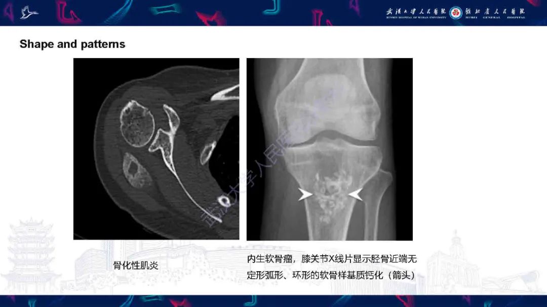 影像PPT - 【PPT】软组织钙化影像诊断-8