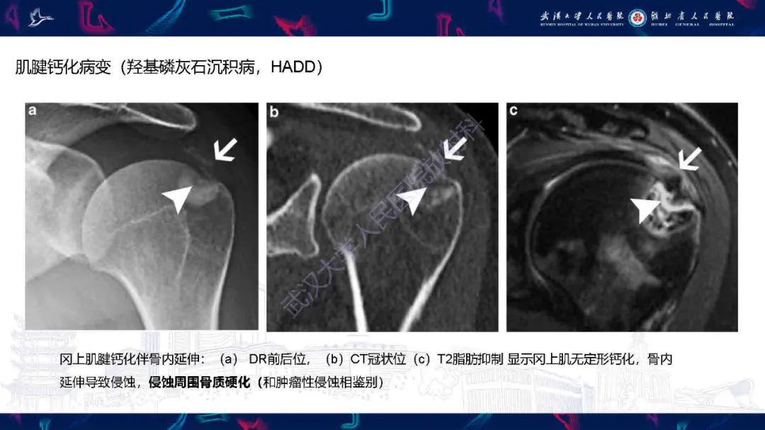 影像PPT - 【PPT】软组织钙化影像诊断-10
