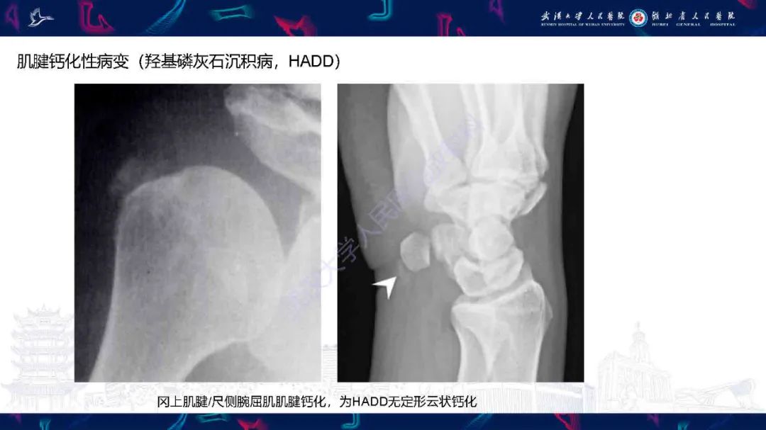 影像PPT - 【PPT】软组织钙化影像诊断-11