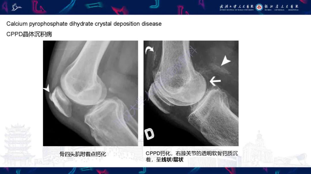 影像PPT - 【PPT】软组织钙化影像诊断-13